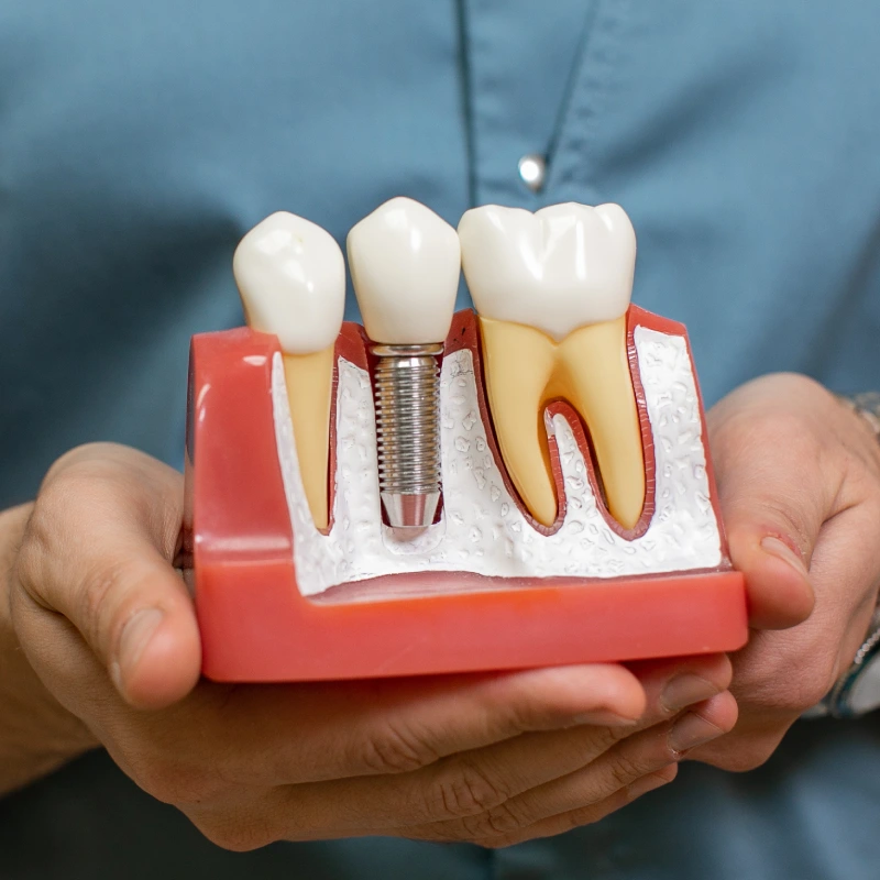 ایمپلنت دندان